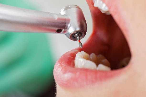 Best Emergency Wisdom Teeth Removal in Madelia, MN